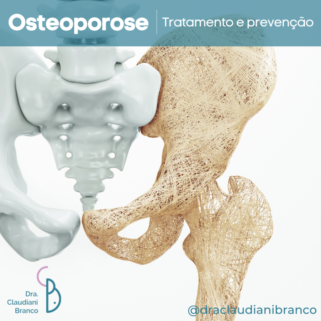 Dra Claudiani Branco fala sobre a Osteoporose, Tratamentos e prevenção.