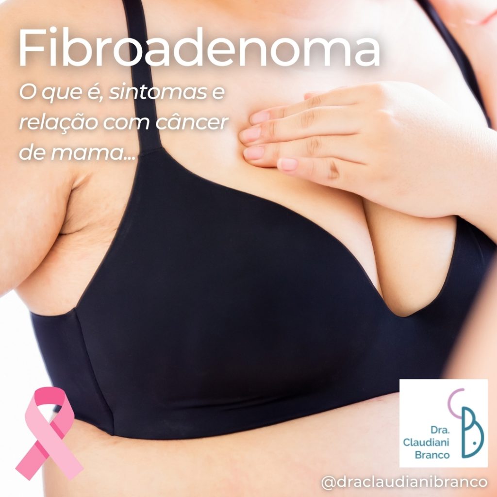 Ginecologista Dra Claudiani Branco comenta sobre o aparecimento do Fibroadenoma e o que isso significa na relação com o câncer de mama.