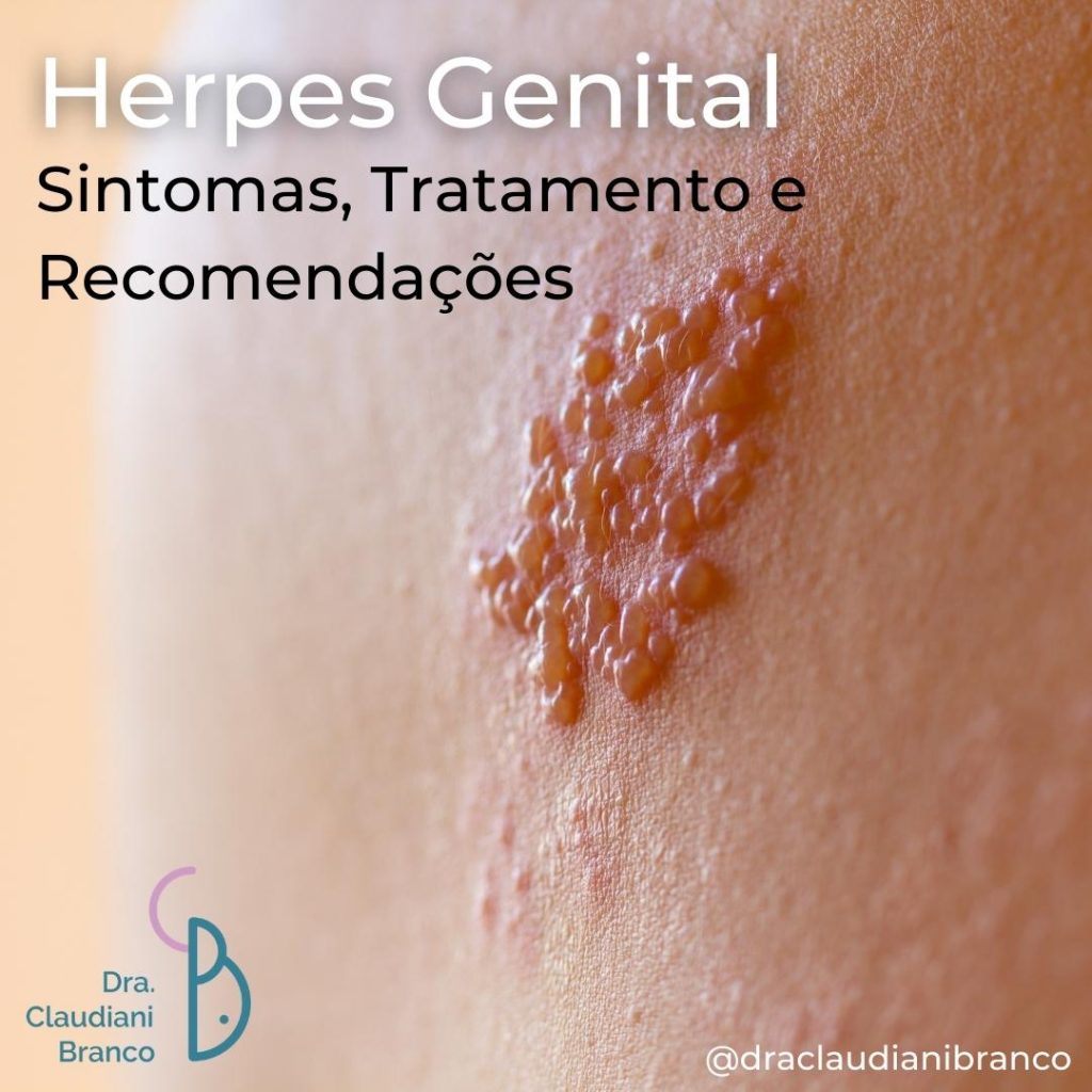 Ginecologista Dra Claudiani Branco fala sobre a Herpes Genital. Foto by Canva.