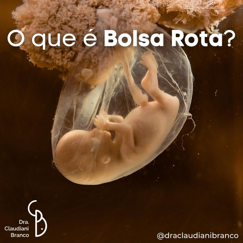 Dra Claudiani Branco Ginecologista e Obstetra explica o que é a Bolsa Rota durante a gravidez.