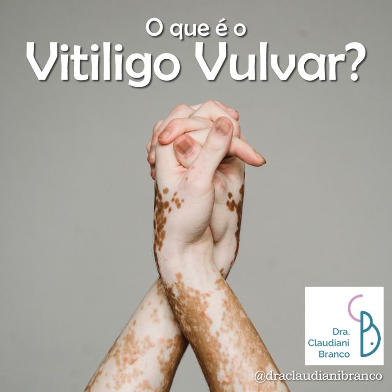 Vitiligo Vulvar Dra Claudiani Alves Branco Gregorin 2836