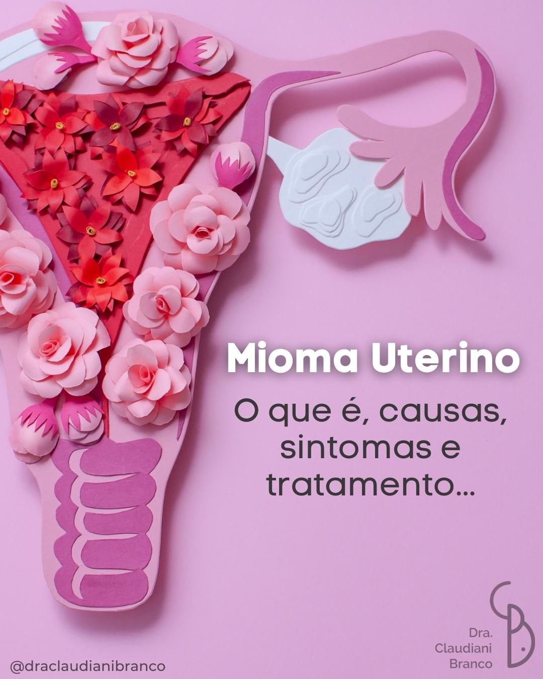 Mioma uterino o que é causas sintomas e tratamento Dra Claudiani Alves Branco Gregorin